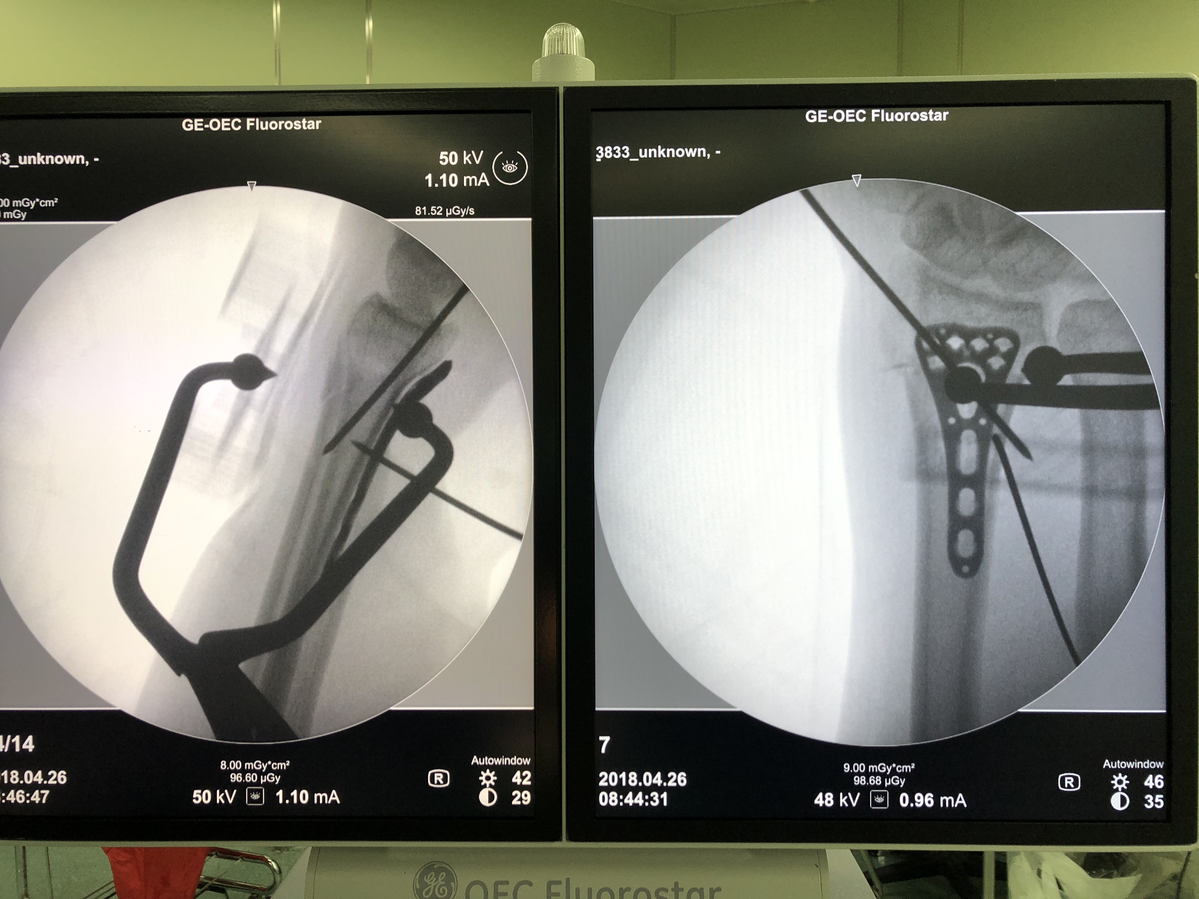 微創遠端橈骨骨折復位鉗 3D 列印輔助器材