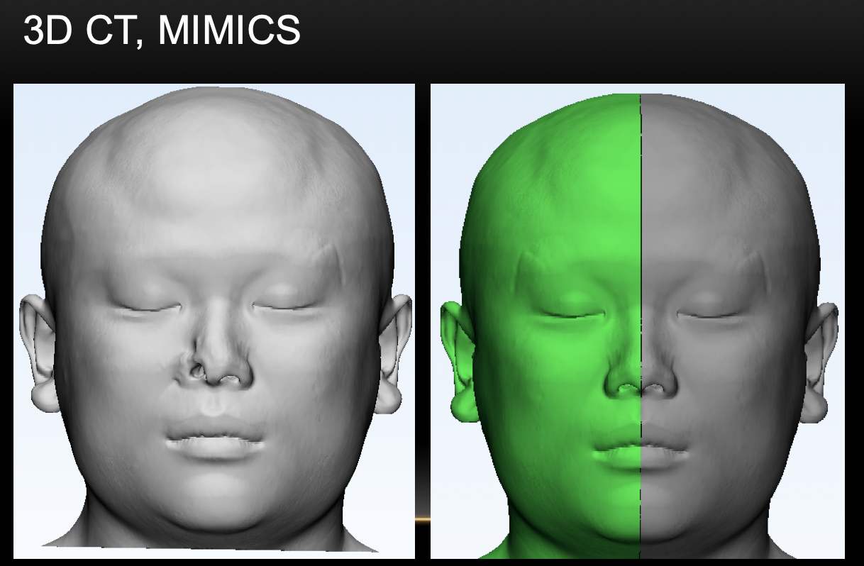 電腦輔助設計3D列印提高半邊鼻重建手術結果