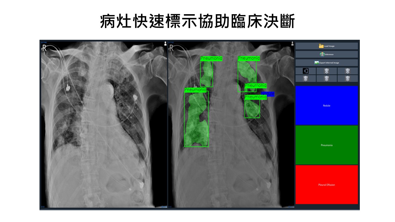 三層雙能數位胸部X光檢查結合雲端分析建立衛星X光中心協助評估肺部問題