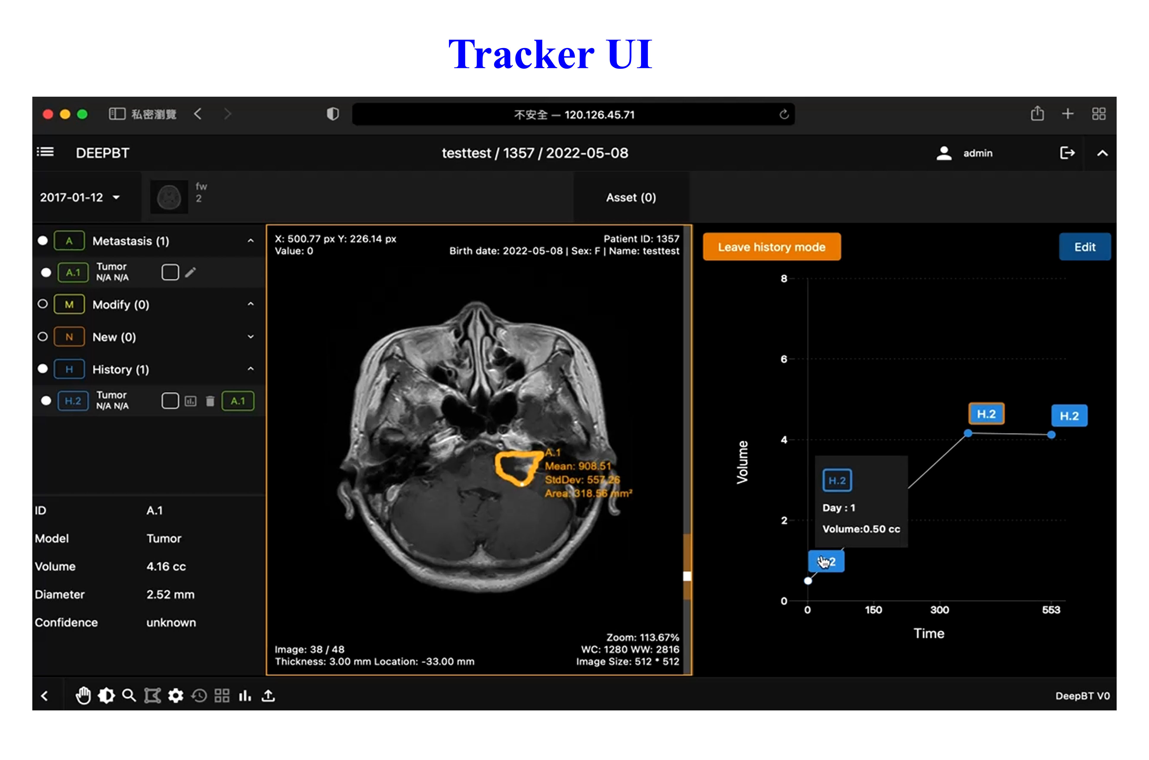 DeepBT腦瘤智慧精準醫療系統：沿時間軸病灶偵測與放射手術療效預測